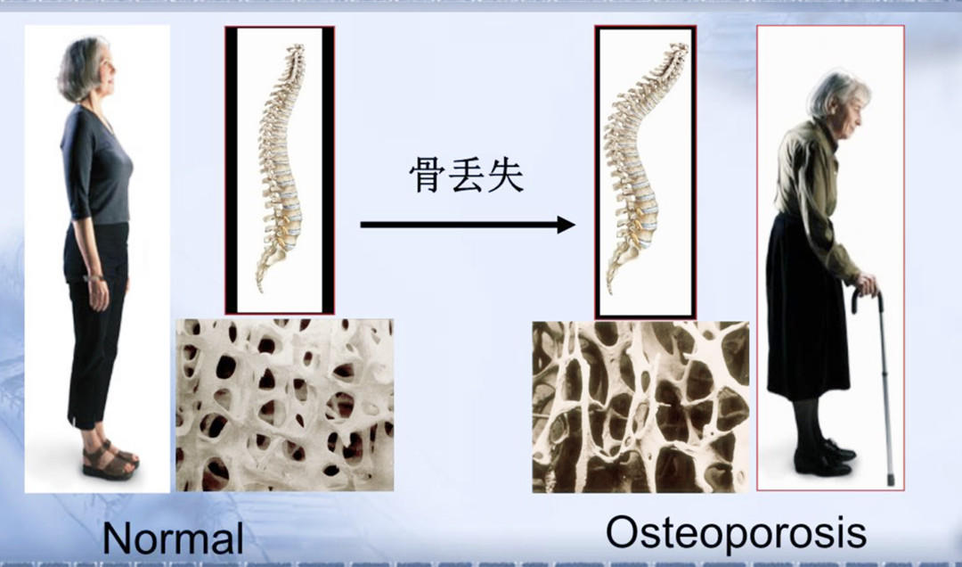 骨質(zhì)疏松癥.jpg